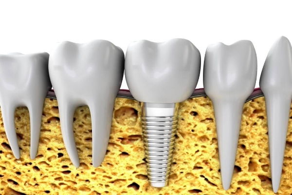 Implantólogos en Margarita - Periodoncistas y Endodoncistas