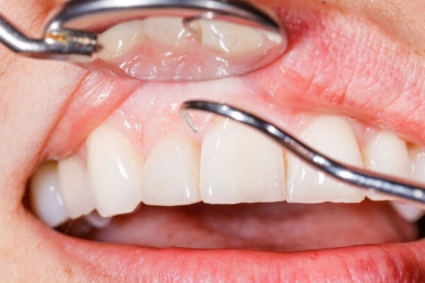 Los mejores implantes dentales de Margarita