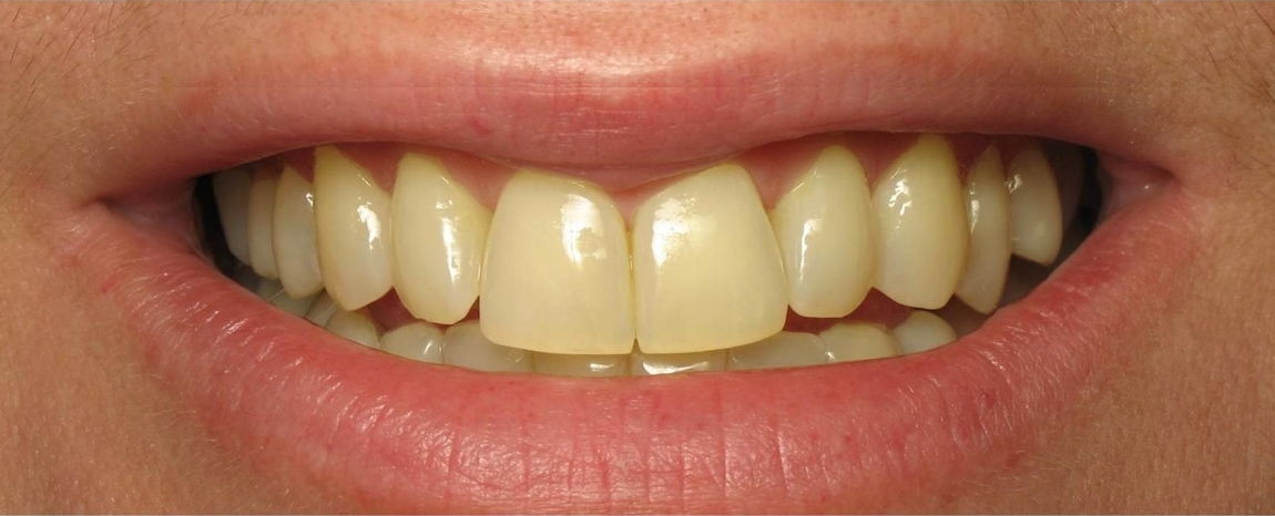 Centro Odontológicos en Margarita - KOi Dental - Antes
