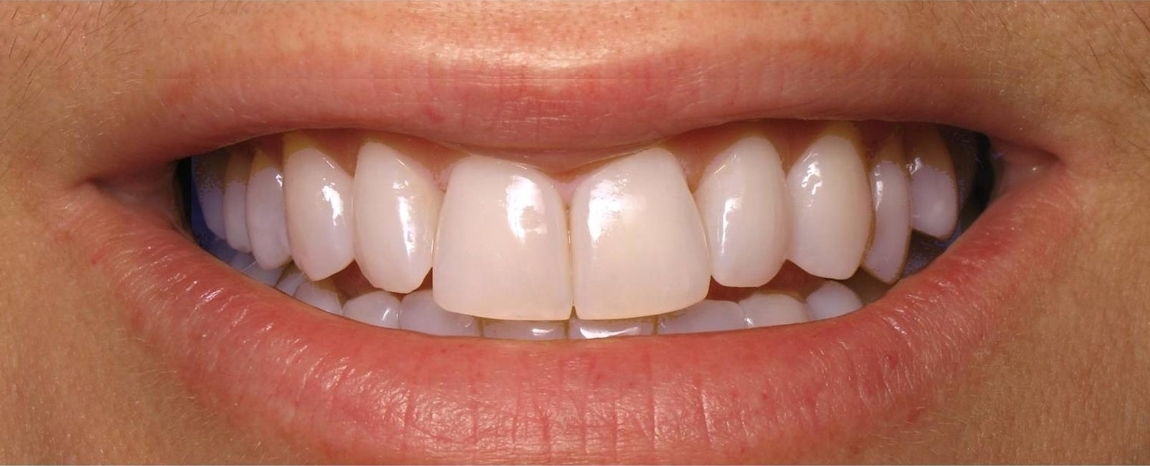 Centro Odontológicos en Margarita - KOi Dental - Después