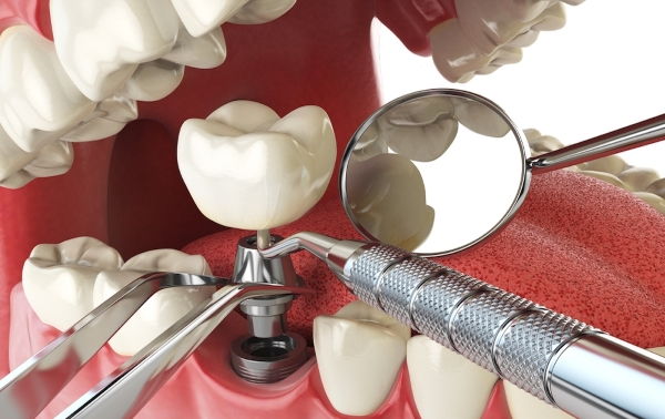 Servicio de Implantología en Margarita - KOi Dental
